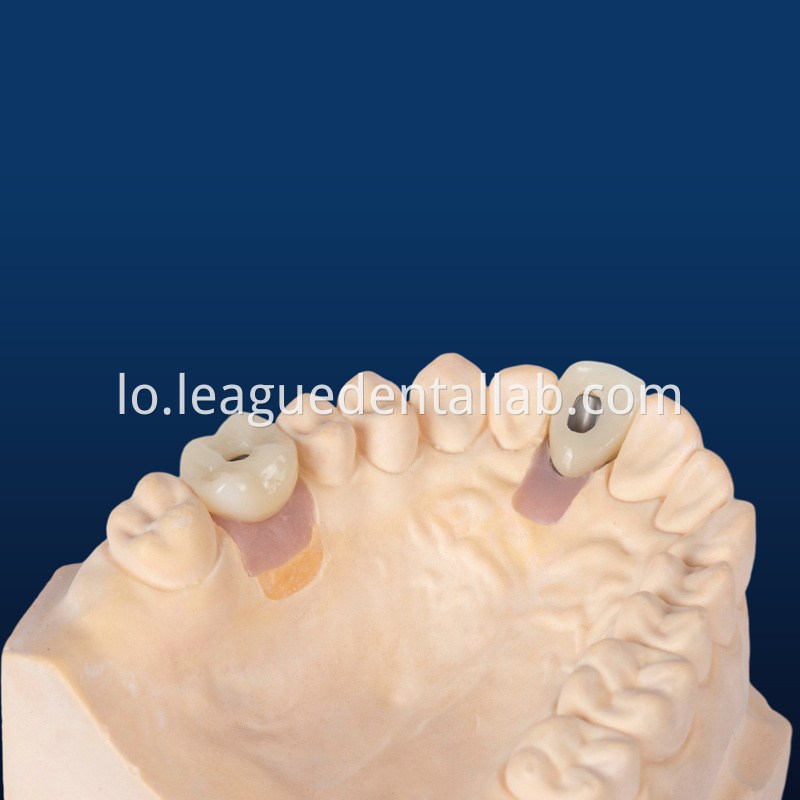 Dental Implant Crown, Dental Implant Zirconia crown,Dental Implant Emax crown,Dental Implant Bridge